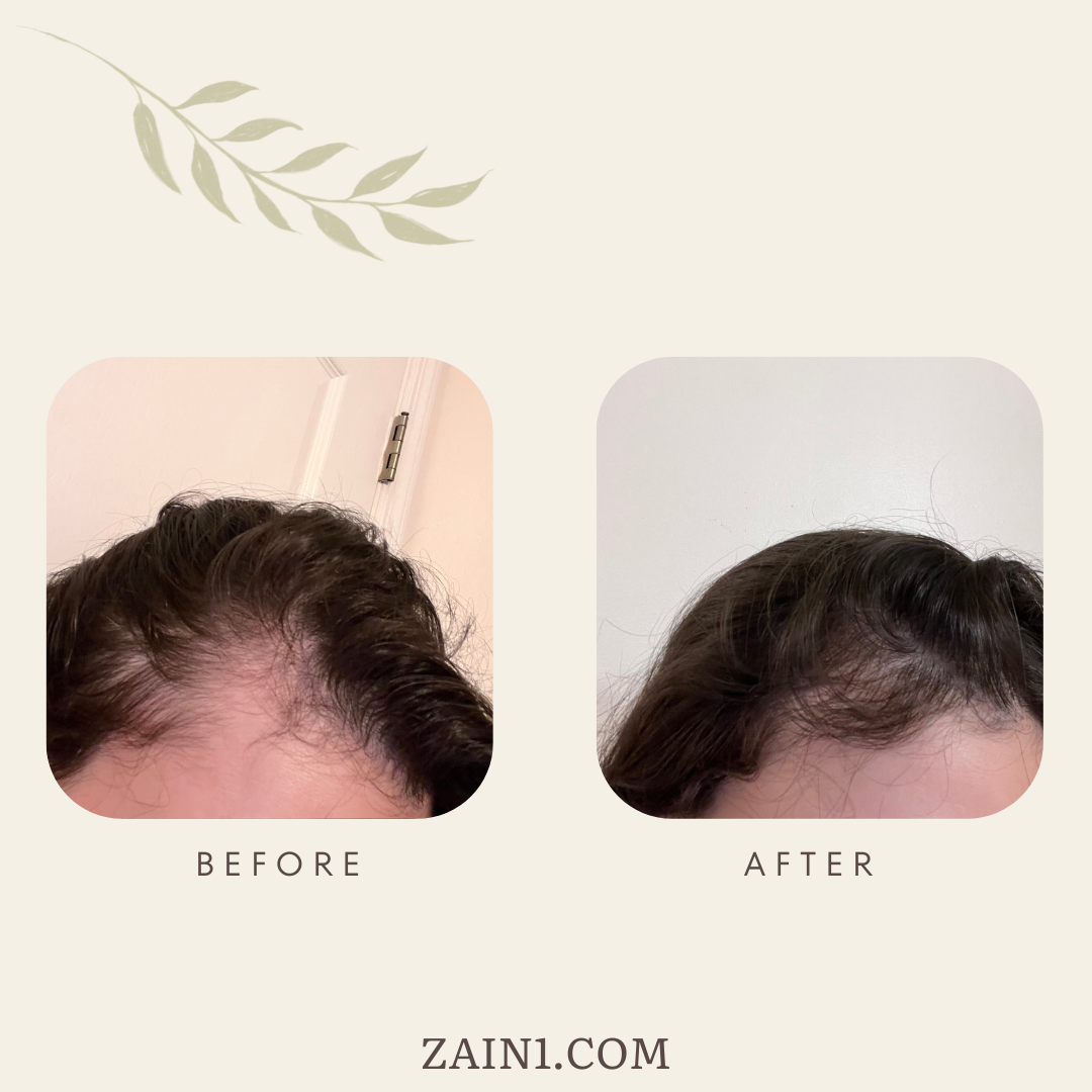 ZAIN1 Hair Growth Serum with Rosemary Extract - For Thicker Hair