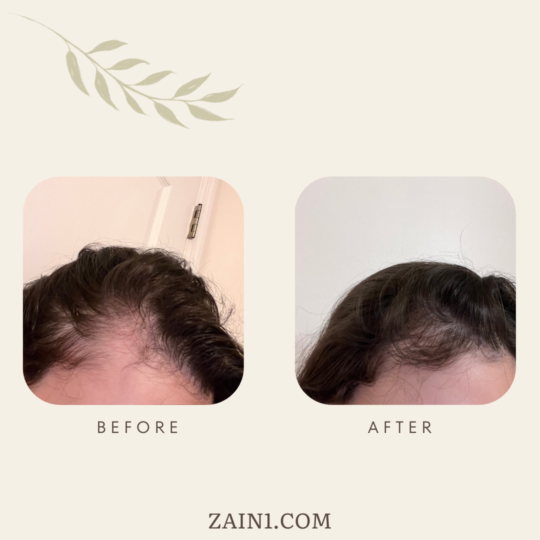 Hair Growth Set By ZAIN1.618